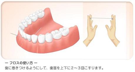 インプラント後の手入れの仕方 インプラント後の手入れの仕方