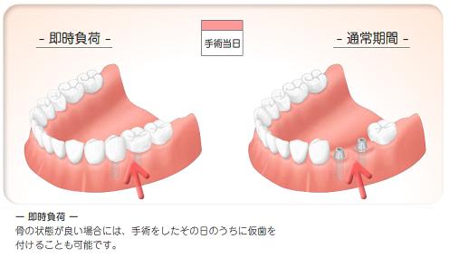 患者さんにやさしいインプラント 患者さんにやさしいインプラント