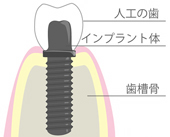 インプラントのとは2