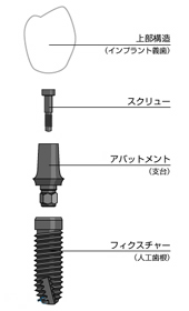 インプラントの構造2