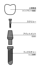 インプラントの構造3